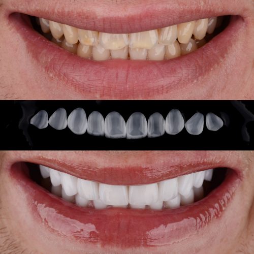 CARILLAS DENTALES ESTÉTICAS