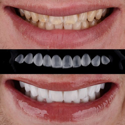 CARILLAS DENTALES ESTÉTICAS