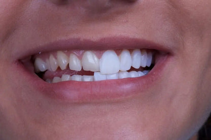 CARILLAS DENTALES ESTÉTICAS